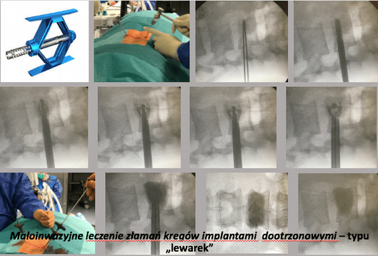 leczenie operacyjne 5