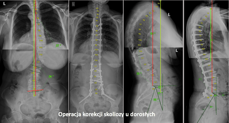 leczenie operacyjne 13