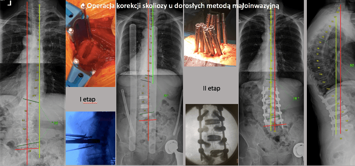 leczenie operacyjne 11